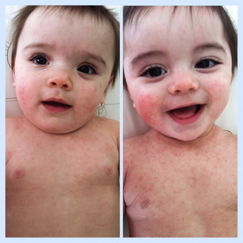 roseola